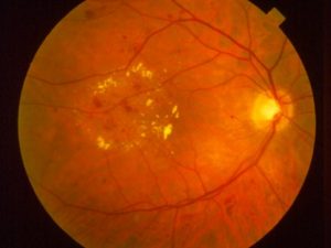 Background Diabetic Retinopathy