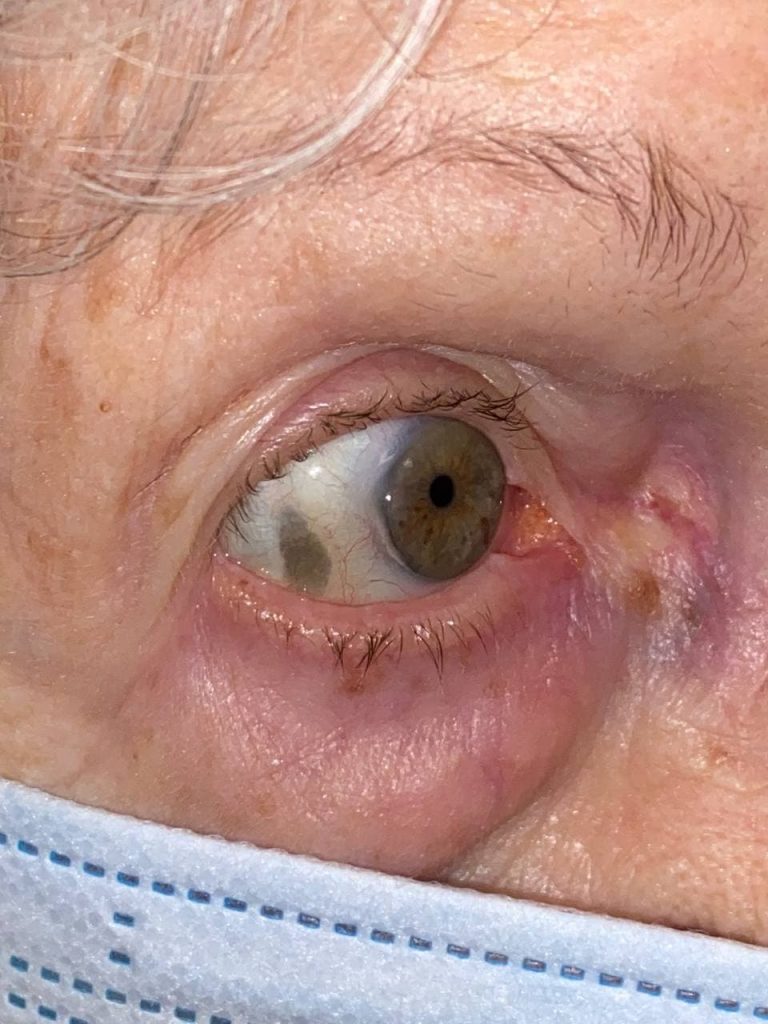 Senile Scleral Plaque - Southwest Eye Institute